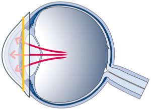 Kontaktlinse als Health Wearable